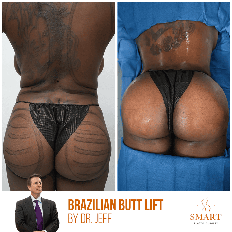 Breast Lift result at Smart Plastic Surgery