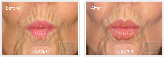 A result from Lupo Center for Aesthetic and General Dermatology