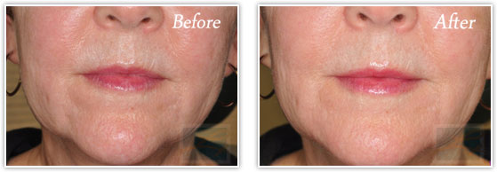 A result from Lupo Center for Aesthetic and General Dermatology