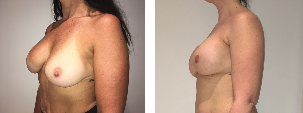 A result from Richard Zienowicz / bodybyZ Plastic Surgery