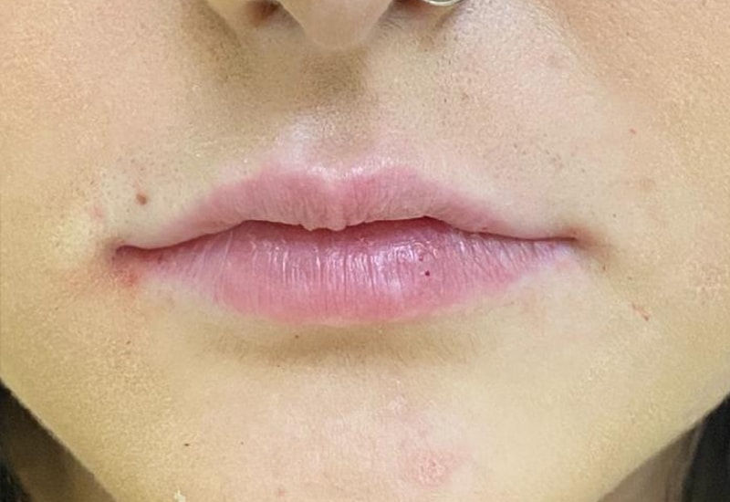 A result from Grace and Glam Medical Spa