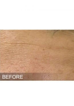 Chemical Peel before photo