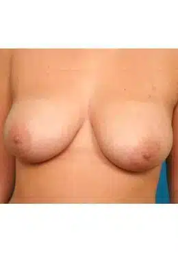 Breast Reduction before photo