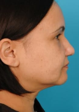 Rhinoplasty before photo