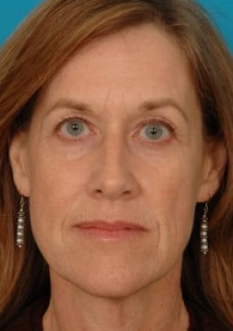 Rhinoplasty before photo