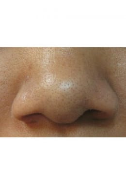 Chemical Peel before photo