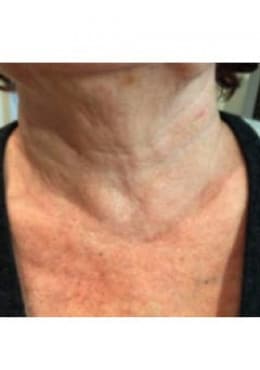 A result from Saltz Plastic Surgery & Saltz Spa Vitoria