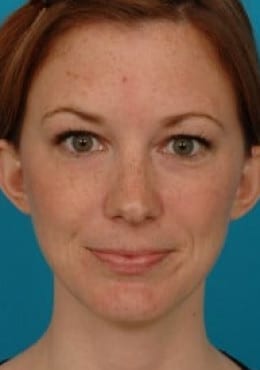 Otoplasty before photo
