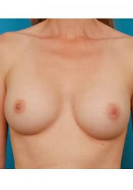 Breast Augmentation result at Saltz Plastic Surgery & Saltz Spa Vitoria