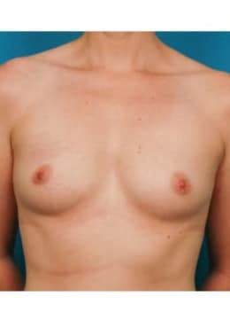 Breast Augmentation before photo