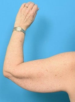 Arm Lift before photo