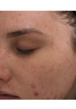Chemical Peel before photo