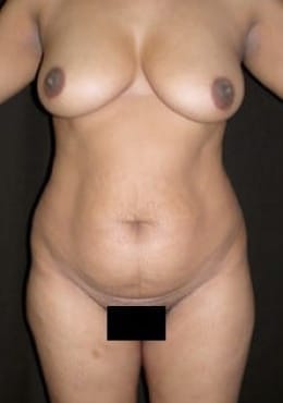 Liposuction before photo