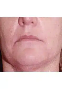 Lip Filler before photo