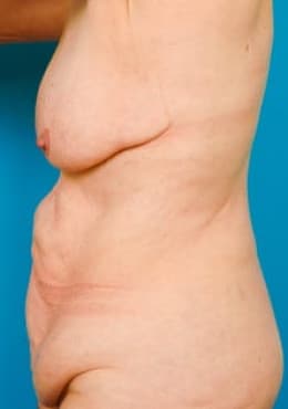 Tummy Tuck before photo