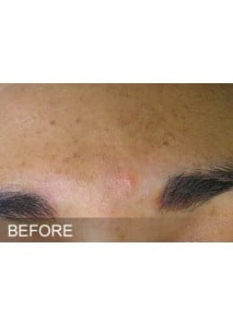 Chemical Peel before photo