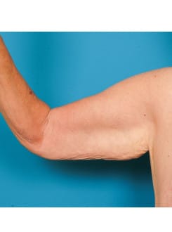 Arm Lift before photo