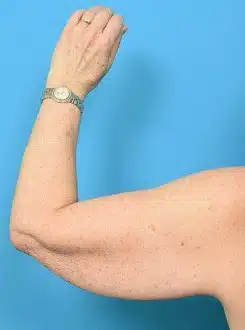 Arm Lift before photo