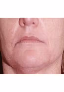 Lip Filler before photo