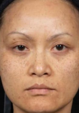 Otoplasty before photo