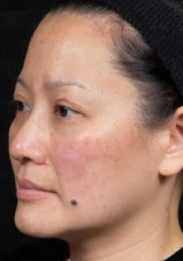 Otoplasty before photo
