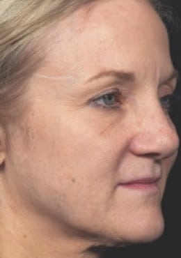 Microneedling before photo