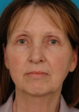 Rhinoplasty before photo