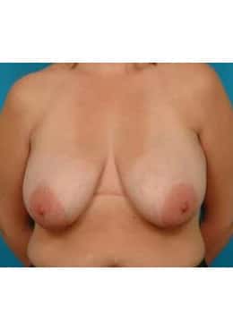 Breast Reduction before photo