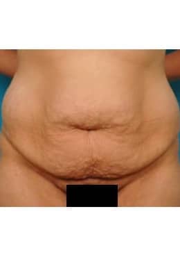 Liposuction before photo