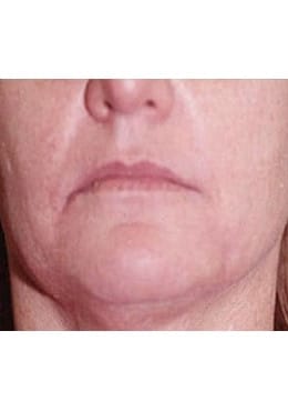 Lip Filler before photo