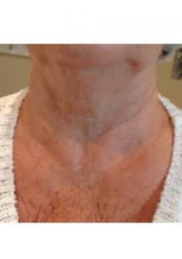 Microneedling before photo