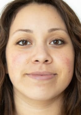 Chemical Peel before photo