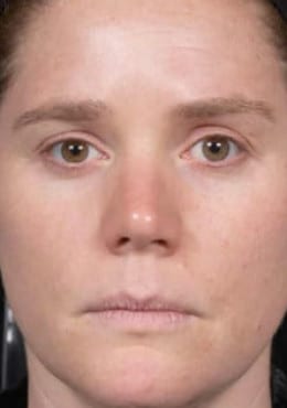 Microneedling before photo