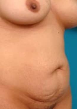 Liposuction before photo