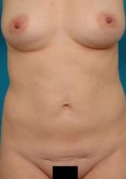 Tummy Tuck before photo
