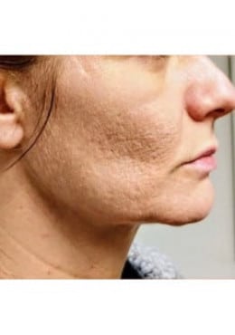 Microneedling before photo
