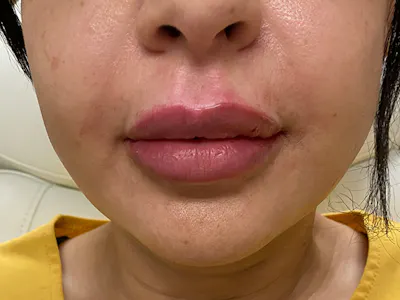 Procedure result at Wirth Aesthetic Plastic Surgery