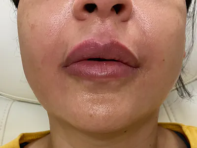 Procedure before photo