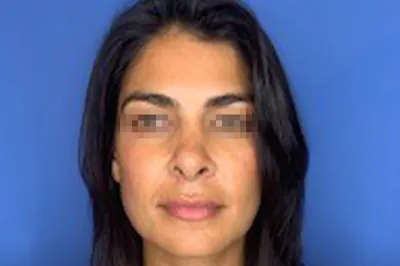 Wirth Aesthetic Plastic Surgery rhinoplasty after — Newport Beach, CA