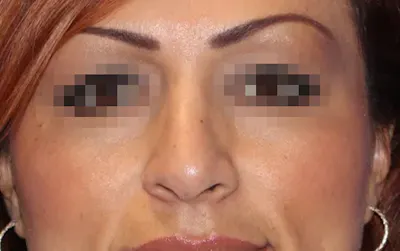 Wirth Aesthetic Plastic Surgery rhinoplasty after — Newport Beach, CA
