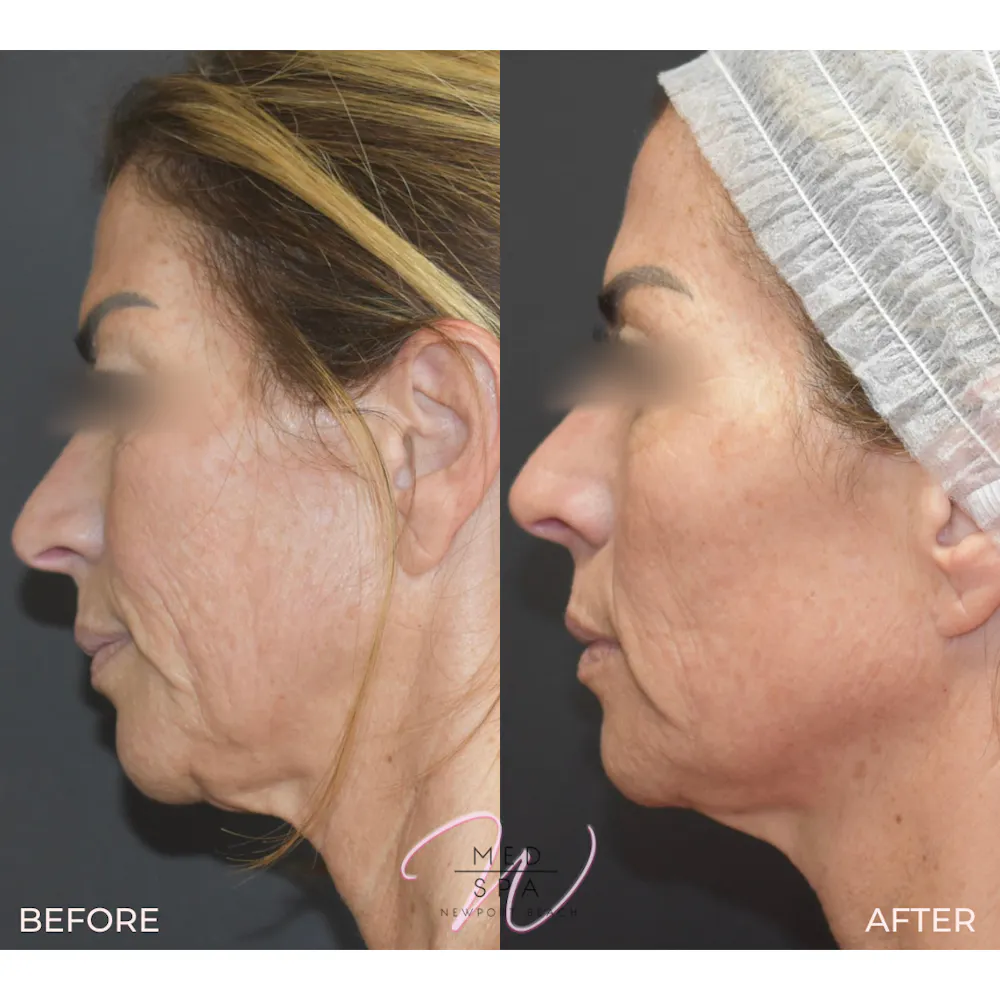 Procedure result at Wirth Aesthetic Plastic Surgery