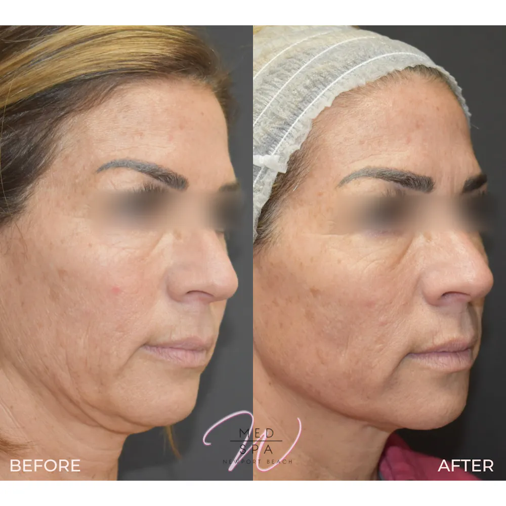 Procedure before photo