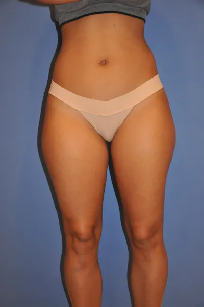 Procedure before photo