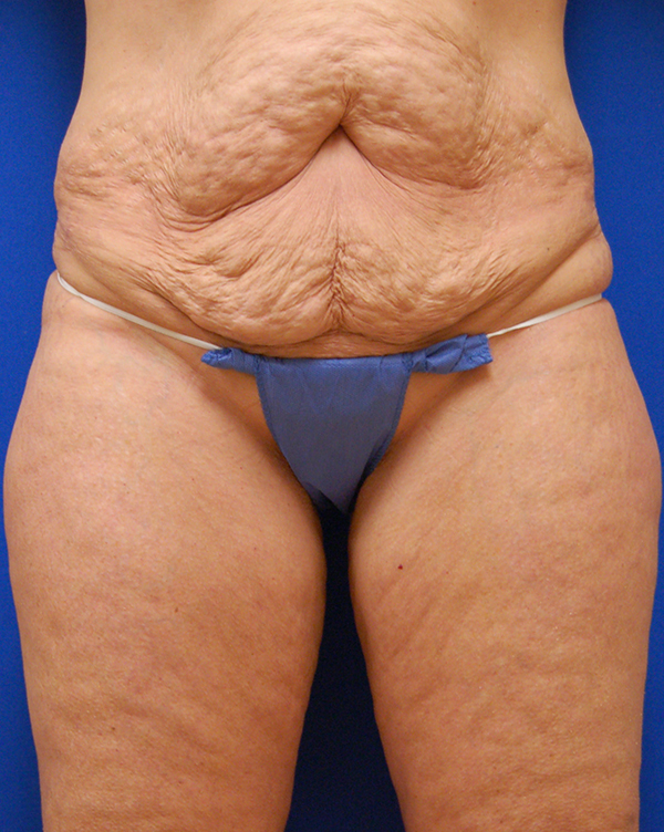 Tummy Tuck before photo