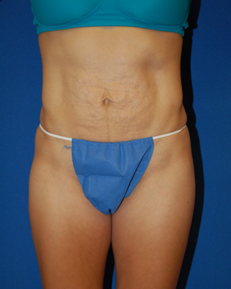 Tummy Tuck before photo