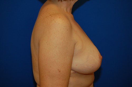 A result from Brzowski Plastic Surgery