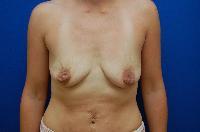 Breast Augmentation before photo