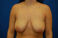 Breast Augmentation before photo