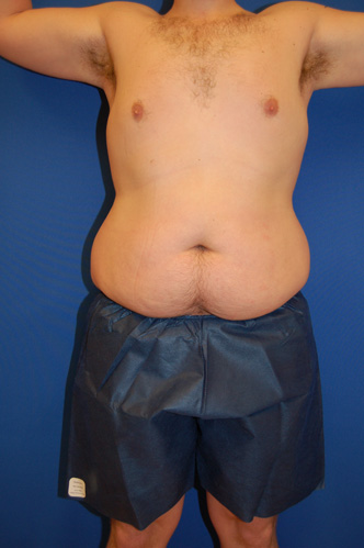 Tummy Tuck before photo