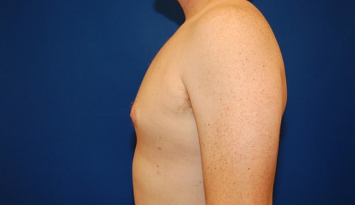 A result from Brzowski Plastic Surgery